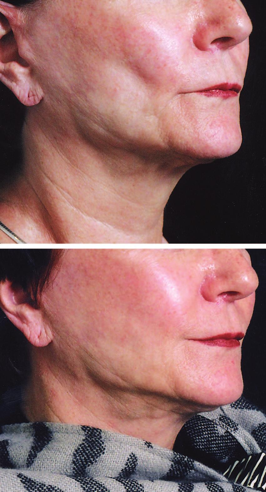 Volume 122, Number 5 Cross-Cheek Depression Fig. 9. A 65-year-old woman after face lift surgery. (Above) She has an obvious and abnormal depression in her cheek.