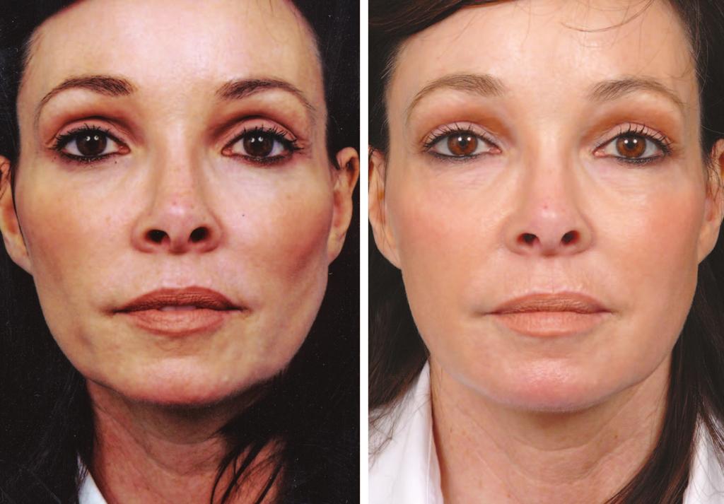 Plastic and Reconstructive Surgery November 2008 Fig. 10. A 44-year-old woman 10 years after a maintenance lift.