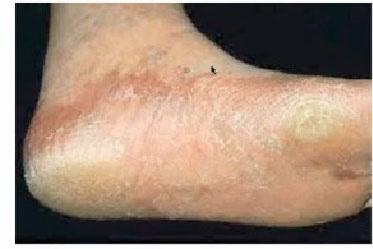 Athlete s Foot Athlete s foot is a fungal infection, tinea pedis, which causes scaling, flaking, and itching of the affected skin. Blisters and cracked skin may also develop.