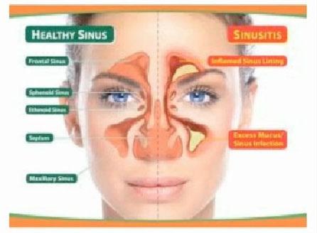 Module 12 - Lesson 4 Sinus Infections (Sinusitis) A sinus infections or sinusitis is basically an inflammation of the sinus cavity. This picture on the right here just shows you the sinus cavity.
