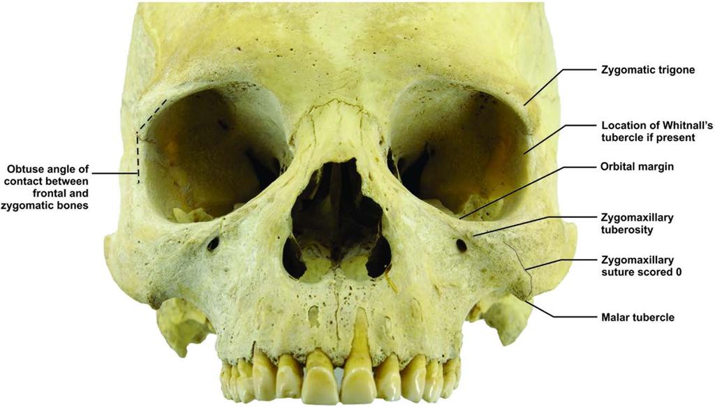 ANCESTRAL VARIATIONS OF THE ZYGOMA 205 Fig. 6. Bony landmarks on Skull in norma frontalis. presented with a greater internal-orbital facial breadth than middle-facial breadth.