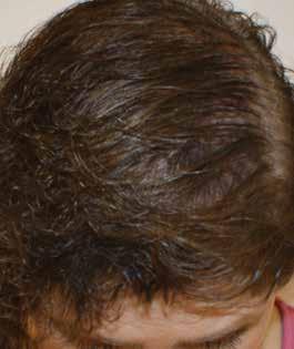 The hair follicles are sensitive to DHT (dihydrotestosterone), which causes them to miniaturize and fall out.