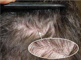 PAI s Choice for FUT Traditional follicular unit transplants (FUT) cannot compare to PAI s specially developed Multi-Unit Hair Grafting (MUHG) procedure.