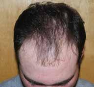 No linear scar means patients can wear their hair extremely short.