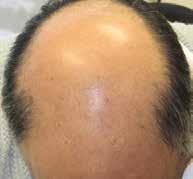 Ideal for patients with significant hair loss, nothing can compare to