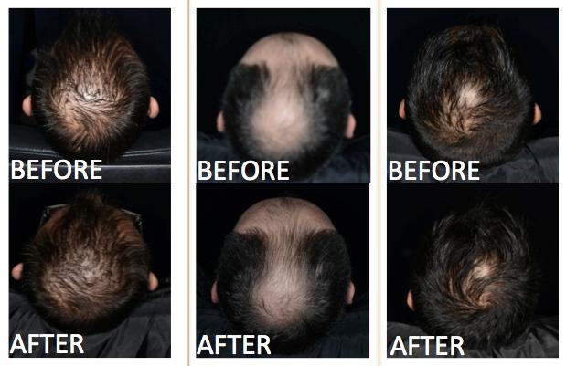10.3.2. Clinical pictures before and after treatment Hair loss was stopped after 3 months of Redensyl daily treatment.