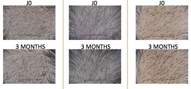 ! Fig 18: Scalp s pictures and phototrichogram pictures of 3 volunteers treated by Redensyl at 3% (macrophotography) Observations of phototrichograms showed after 3 months a thickening effect of