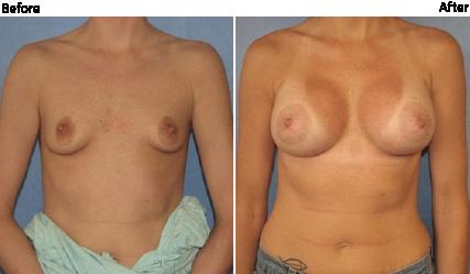 Tattoo Removal The best candidate for a 410 implant is a relatively thin woman without a lot of breast tissue who s looking for a softer transition at the top of the breast.