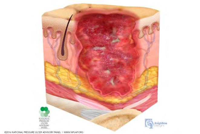 Stage 3 Full-thickness loss of skin, in which adipose (fat) is visible in the ulcer and granulation tissue and epibole (rolled wound edges) are often present. Slough and/or eschar may be visible.