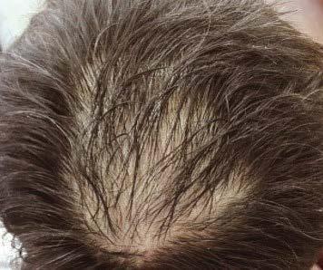 [1/cm 2 ] Hair Thickness
