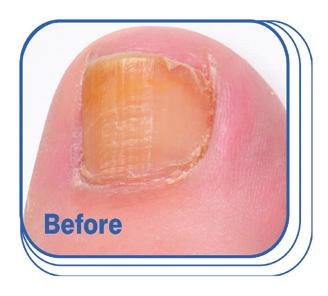 For ages 12+ Directions for use: Between the toes only: Apply twice a day (morning and night) for 1 week or as directed by a healthcare professional.