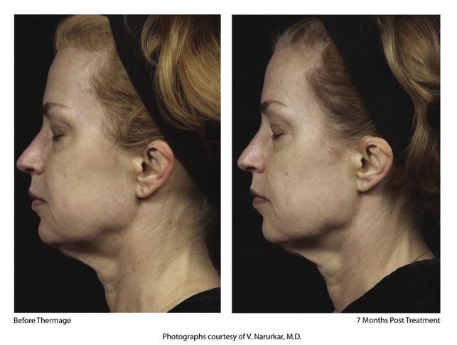 SOLUTIONS FOR TODAY'S AESTHETIC PATIENT Photos courtesy of Vic Narurkar, MD THE GIST Thermage is a safe, effective, no downtime skin tightening treatment.