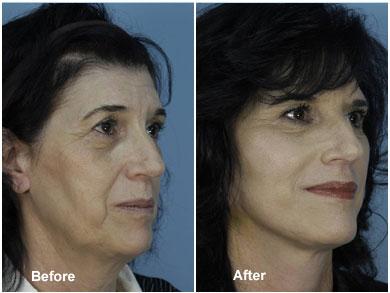 The "QT Mini Facelift" offers all the benefits of a full facelift with little down time and at about half the cost. A new low downtime facelift developed by Dr. William E Silver and Dr.