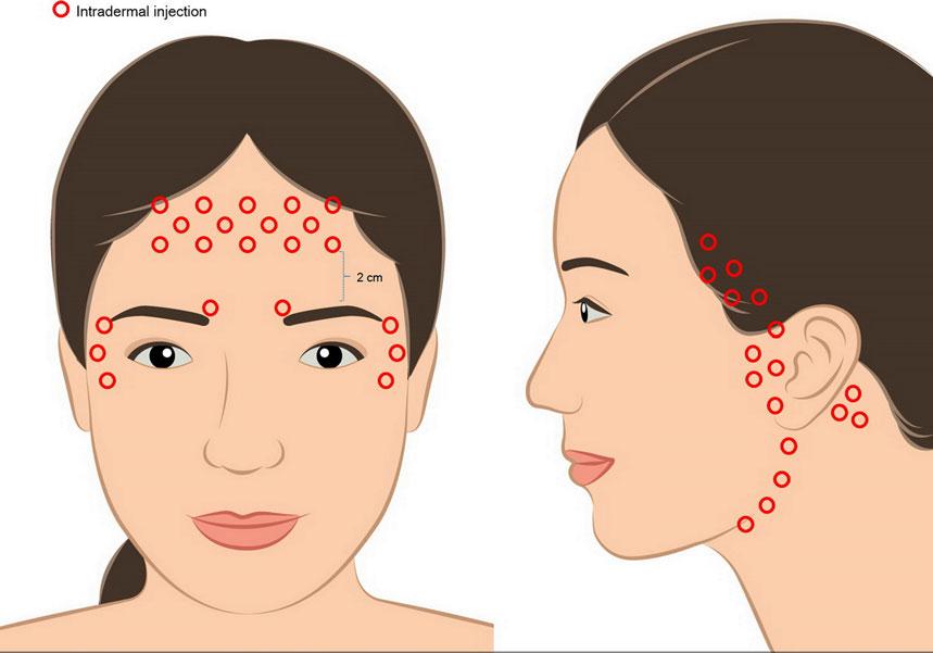 Figure 1 The Illustration demonstrating injection sites for intradermal ABO injection for face-lifting purpose. 75%, and 76 100% improvement.