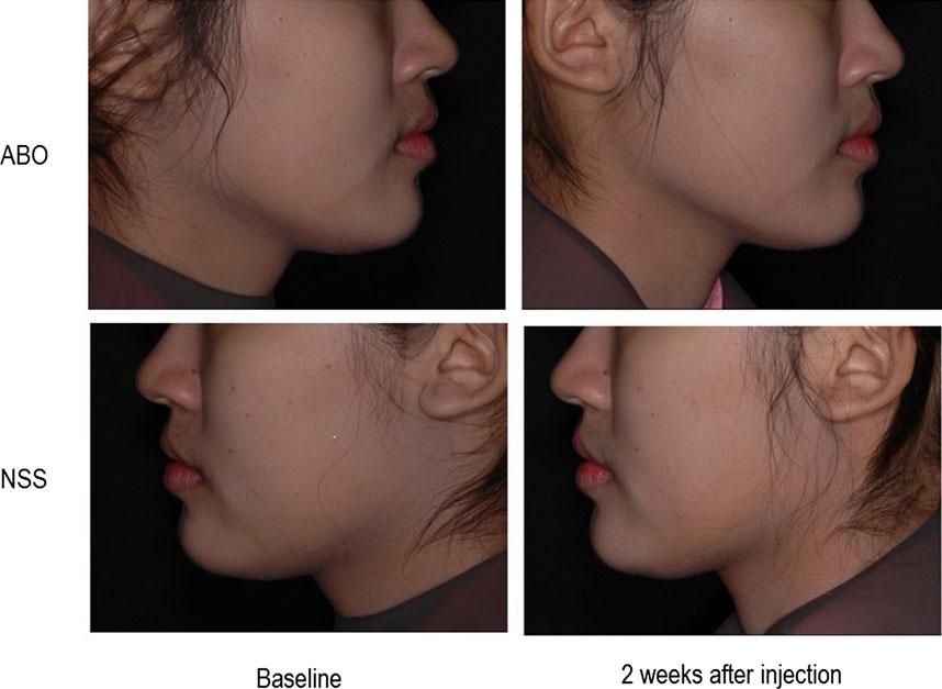 Figure 2 Clinical improvement of skin laxity of a representative case at 2 weeks after injection was demonstrated.