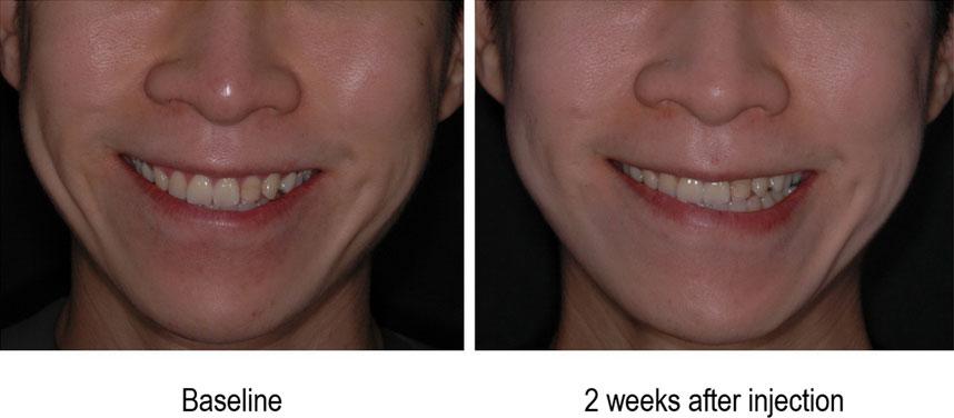 9 and 95% confidence interval of 1.1 56.1. In contrast, the dosage of ABO has no influence on clinical result of face-lifting. According to patient evaluation survey, 12 (54.