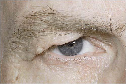 164 Aesthetic Surgery Journal 31(2) Figure 1. This 61-year-old man presented to the senior author (HMS) for blepharoplasty. This is a good example of a patient with mobile, ptotic brows.
