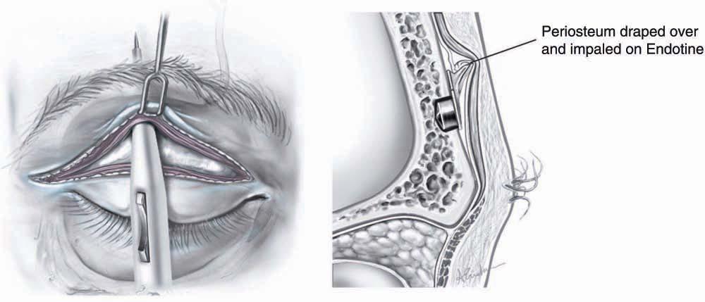 Cohen et al 165 Figure 3. A cephalic dissection is performed with a transeyelid approach to orbital rim and frontal bone (left). The Endotine fixation device is shown from a parasagittal view (right).