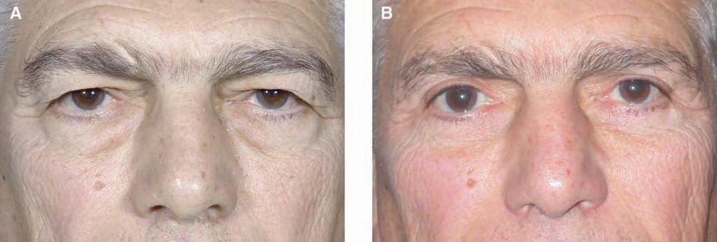 Cohen et al 167 Figure 5. (A) This 69-year-old man presented with ptotic brows and significant hooding of brow tissue.