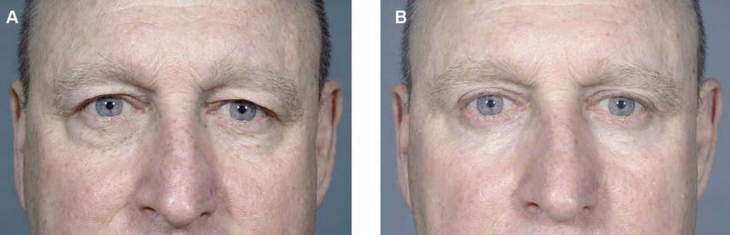 (A) This 58-year-old man presented with ptotic brows, a high forehead, and male-pattern baldness. (B) Eight months after brow stabilization and upper eyelid blepharoplasty.