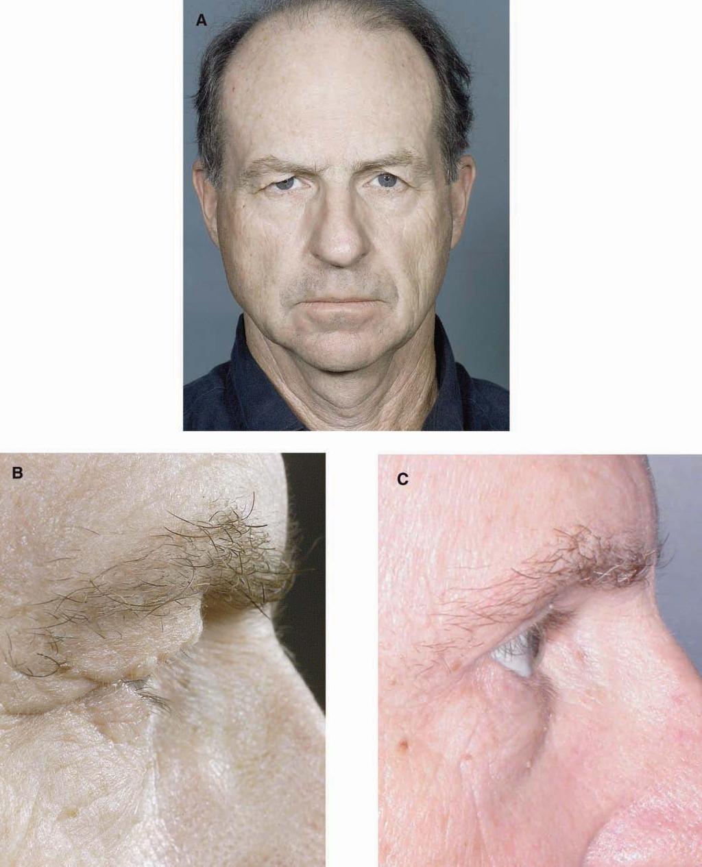 168 Aesthetic Surgery Journal 31(2) Figure 7. (A, B) This 61-year-old man presented with ptotic brows, male-pattern baldness, and hooding of the brow over the eyelid.