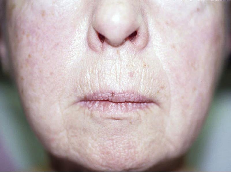 Aesthetic assessment - AGING lengthening of the cutaneous portion of the upper lip and volume loss and thinning of the upper