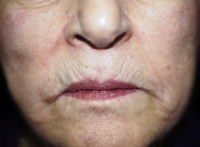AGING of Lips and Lower Face Formation of jowls and vertical geniomandibular The lip margin may become blunted Flattening of the