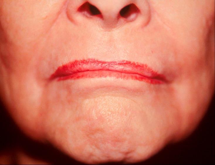 AGING of Lips and Lower Face Loss of projection of the Cupid s bow pallor of the vermilion loss of sharp vermilioncutaneous junction