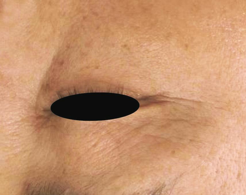 The periorbital area is a particular lesion to treat due to its unique characteristics that it has continuous movements and that the eyelid skin is the thinnest part among body skin with about 0.