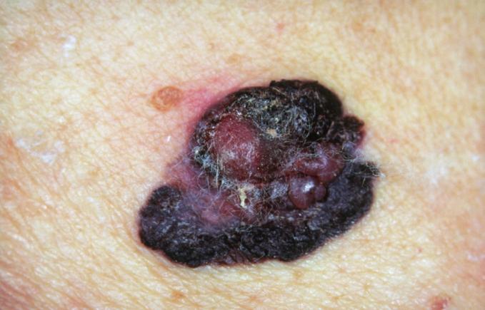 Even if a spot is cancerous, simple modern treatments can usually cure it and most do not spread to other parts of the body. The smaller the spot the easier it is to cure.