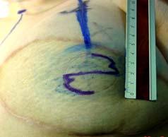 Table III. Results of the reconstructed nipple projection. Projection created at Range 5-22 surgery (Millimeters) Mean 11.