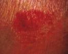 Glossary Wound Care Pressure Ulcer Stages: Suspected Deep Tissue Injury: Purple or maroon localized area of discolored intact skin or blood-filled blister due to damage of underlying soft tissue from