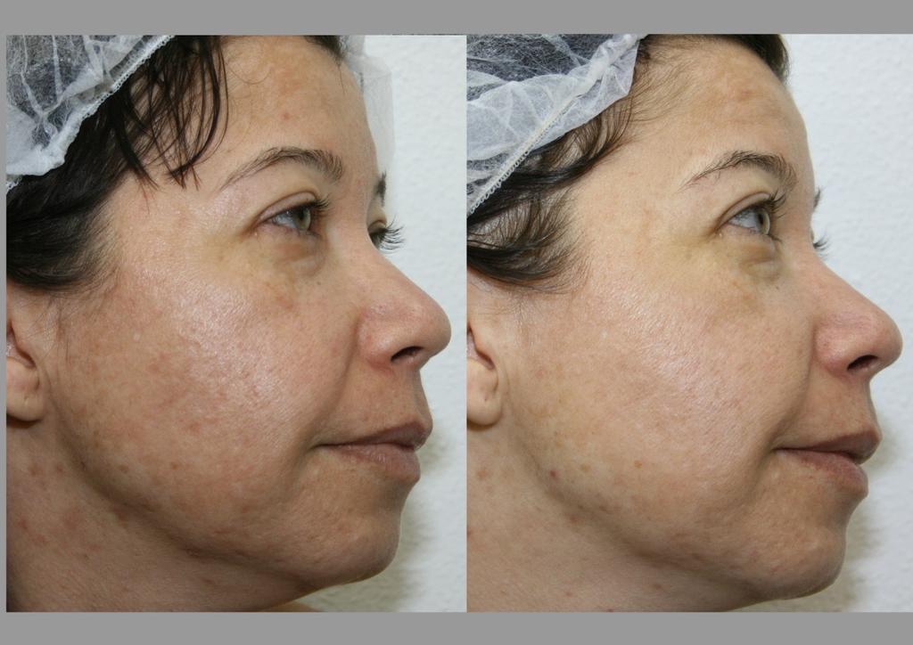 Fig. 5: 42-year-old patient with melasma after