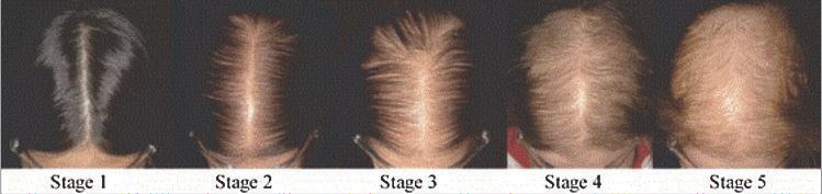 HAIR TRANSPLANTATION Chapter 3 13 Fig. 1. Sinclair Scale for Grading Female Pattern Hair Loss. Stage 1 is normal.