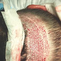 Chapter 3 HAIR TRANSPLANTATION Evaluation for Follicular Unit Extraction (FUE) 28 In evaluating a person for follicular unit extraction, it is necessary to make sure there is sufficient