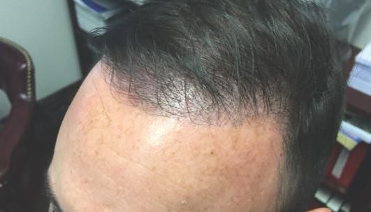New Double-Mega FUE Procedure Using a newly developed technique, the Double-Mega Procedure, we are able to transplant 5000+ grafts - enough to cover almost all cases of baldness - in