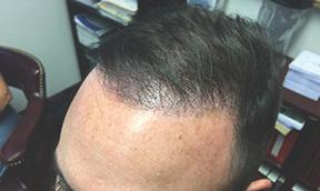 Patient had 3000 grafts by strip