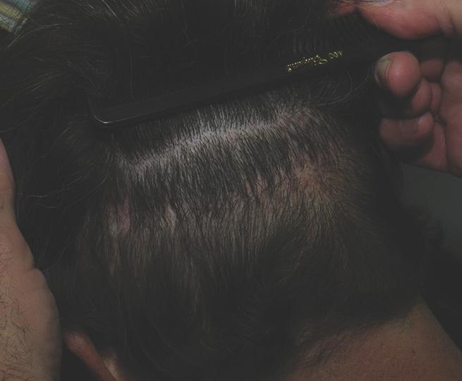 varying from.8 to 1.0 mm, and the multiple FUE method which uses a 2.25 mm hole. Both heal quickly. The 2.