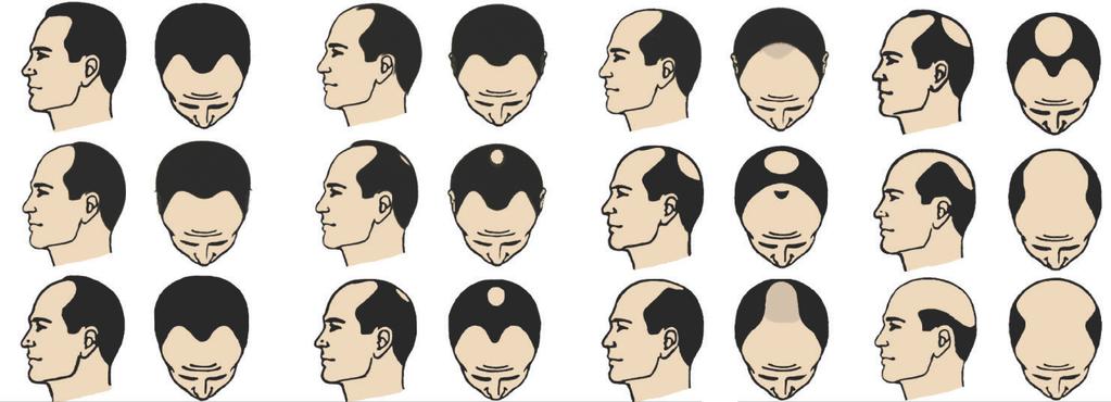 PHYSICIAN USE ONLY NORWOOD HAIRLOSS PATTERNS 2 3A 2A 3V 3 4 XMAS Pattern Female Ludwig Pattern s I, II, and III 4A 5 5A 5V 6 7 TELEMEDICINE 79
