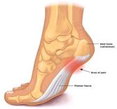 WELLNESS SPOTLIGHT What is it? Plantar Fasciitis Plantar Fasciitis is a chronic local inflammation of the bowstringlike ligament that stretches underneath the sole of the foot.