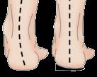 tendonitis pain Compensates for leg length