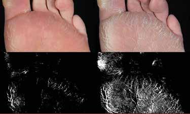 First, as a soft, semi-solid, it conforms perfectly shaping around even tiny prominences, toes, feet and body contours.