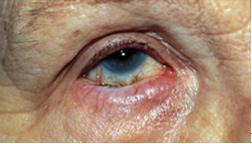 Bottom, from Channing, Albucasis Ectropion 2- Entropion and Ectropion -In the treatment of Entropion, Al Zahrawi advised eversion of the eyelid with fingers or with a traction suture.