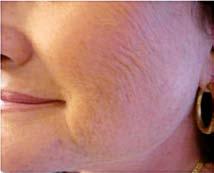 immediate and long-lasting healthy, glowing skin; optimized dermal restructuring over time.