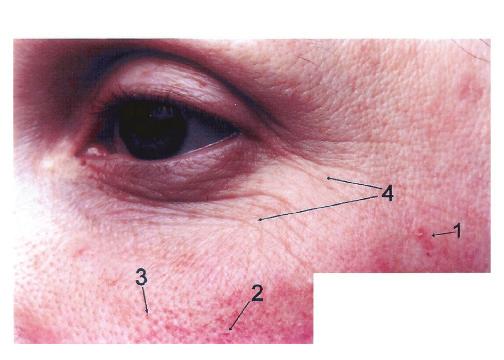 BEFORE use of Renewal Product AFTER 12 weeks use of Renewal Product Analysis of Controlled Usage Study Using a Renewal Facial Product BEFORE 1. Actinic keratosis lesion 2. Field of telangiectasias 3.