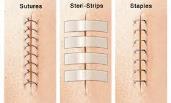 Fill in the Gaps Suture Removal Fill in the blanks. 1. Check instructions. 2. Explain the procedure to the patient; provide if required. 3. Wash your hands and wear to remove dressing 4.