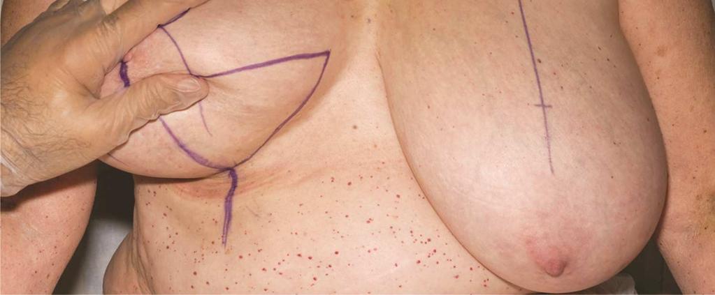 Plastic Surgery: An International Journal 2 The Main Body of the Paper Materials A ruler or measuring tape; an indelible marker pen.