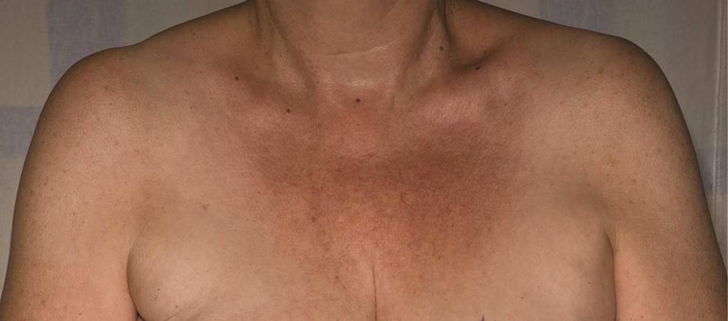 It is worth noting that this patient had an earlier partial right mastectomy highlighting that this technique is applicable to create symmetry in preoperatively symmetrical and near symmetrical