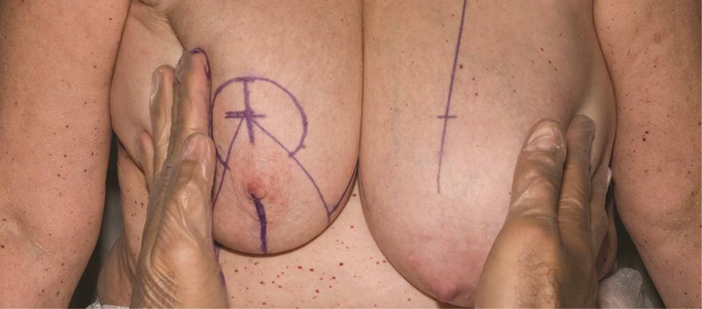 The breast meridians, the inframammary folds (in their central portion only), and the new nipple positions were marked bilaterally.