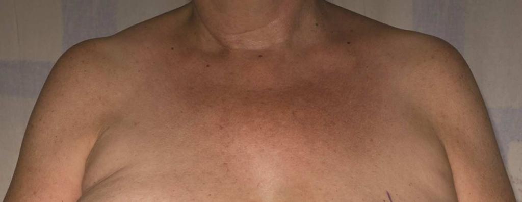 Figure 4: Photograph with the Medial Markings on the Second (Left) Breast Having